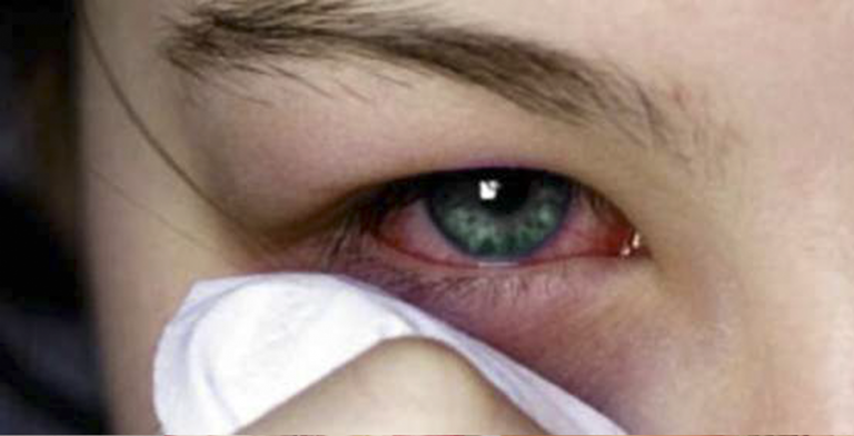 Secretario de Salud minimiza la conjuntivitis en Yucatán