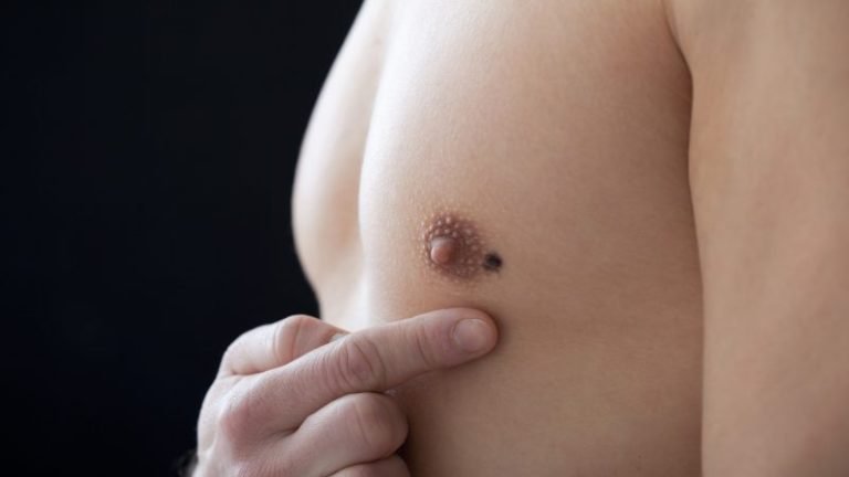 Ellos también cuentan; las cifras del Cáncer de Mama masculino