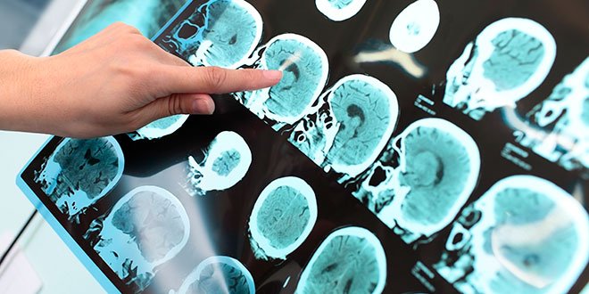 Terapia de ultrasonido para prevenir el Alzheimer