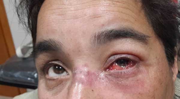 conjuntivitis-junio